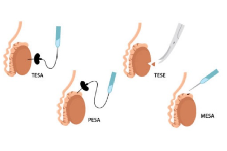 Surgical-Sperm Retrival